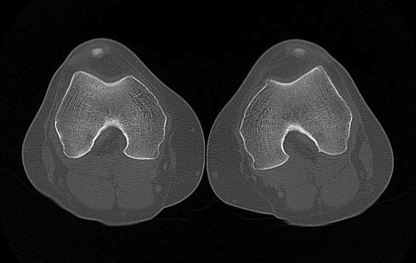 Axial CT PFJ